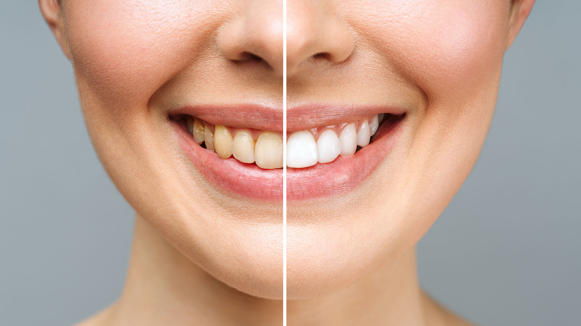 Jenison Zoom! Teeth Whitening Dentists 2